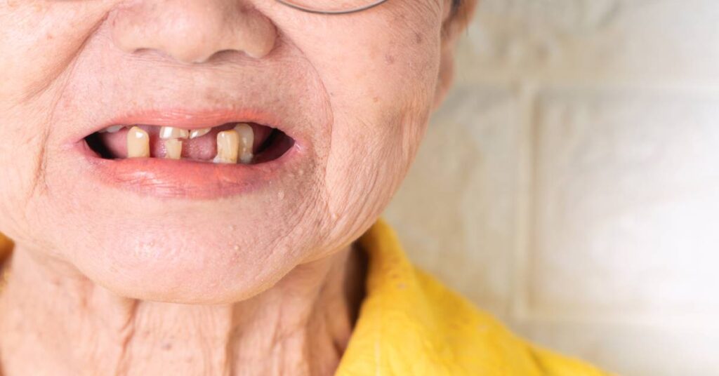 An older woman wearing glasses and a yellow shirt has her mouth open. She has several broken and missing teeth.