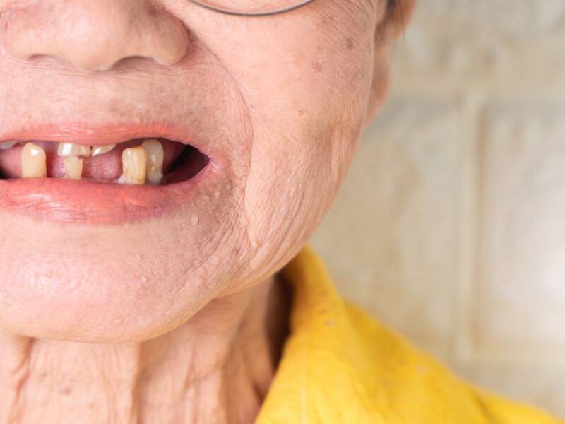 An older woman wearing glasses and a yellow shirt has her mouth open. She has several broken and missing teeth.